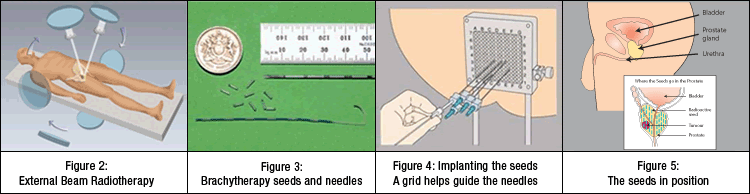 Radiotherapy infographic